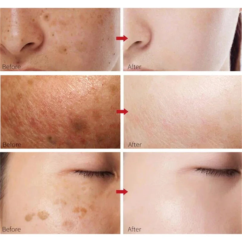 NNEOBA Whitening Freckles Cream - Korean Skincare